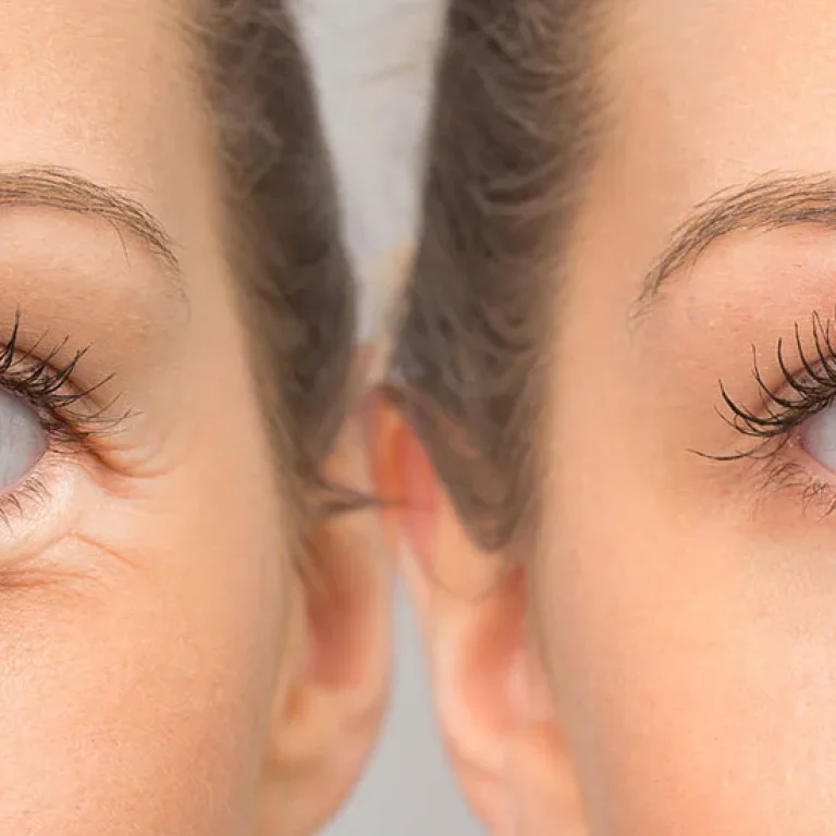 gozalti-torba-estetigi